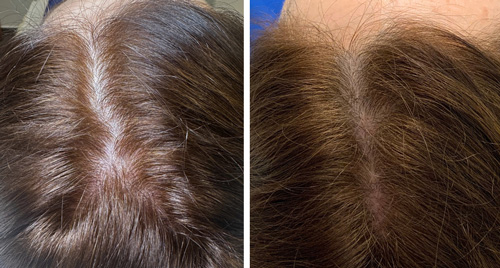 tratamiento autólogo regenerativo para la caida del cabello en donostia-san sebastián